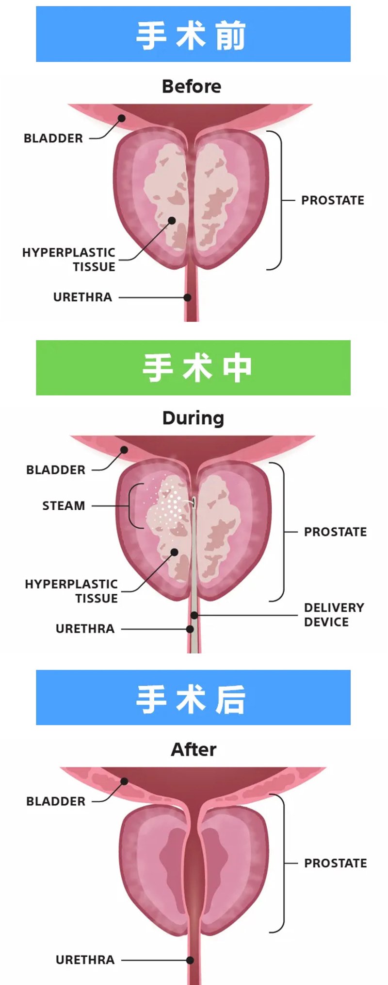 大理包皮手术